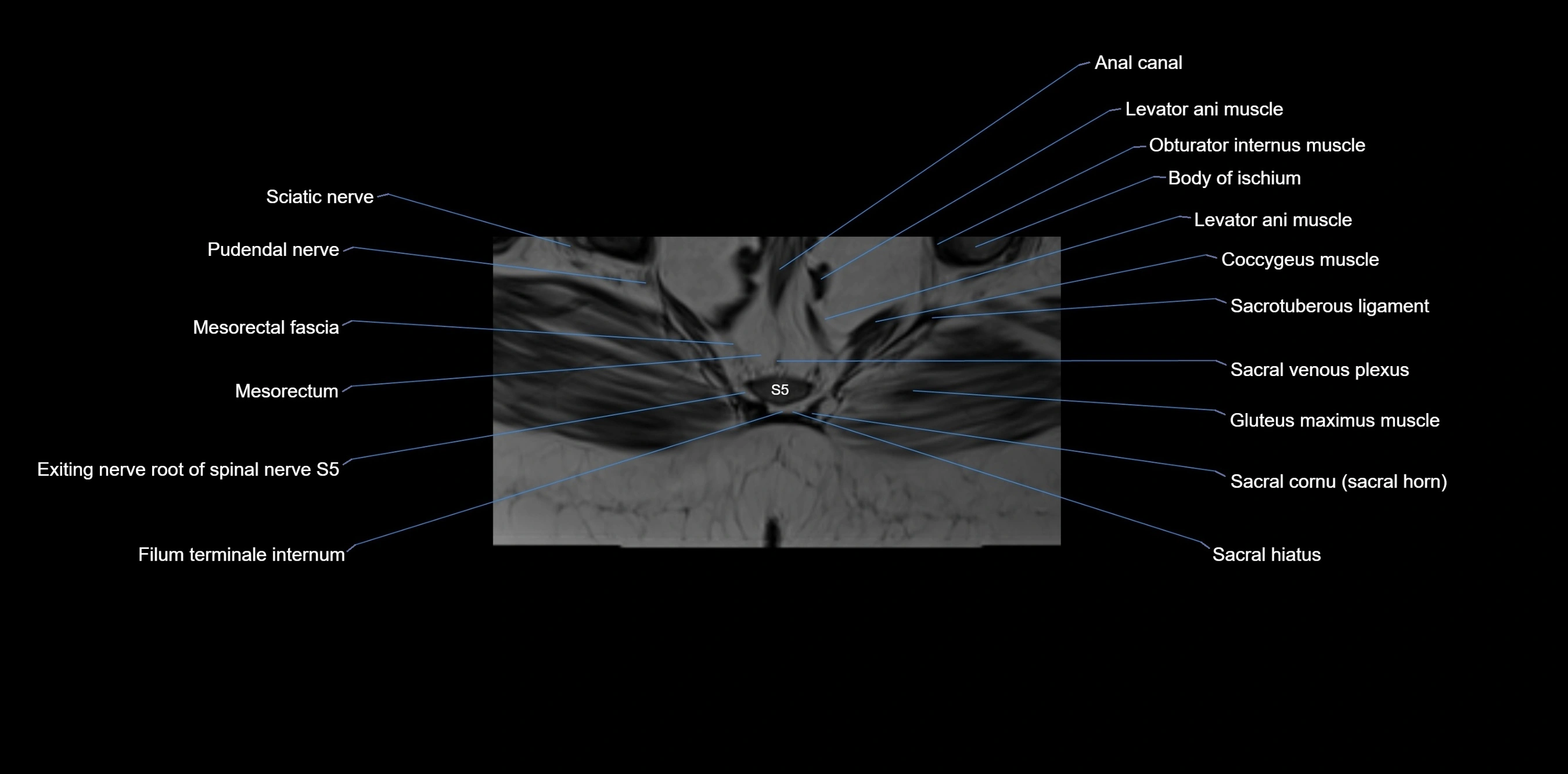 MRI sacrum, coccyx and sacroiliac joint axial cross sectional anatomy 3T  radiology  image-img-00001-00062.webp